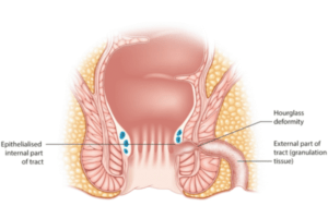 Fistulotomy