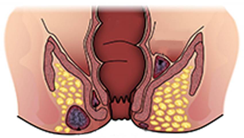 What is a Anorectal Complex Fistula?- Kaizen Fistula Care