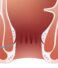 Anorectal Fistula in Female
