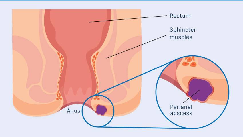 Preventing Recurrence: Tips for Anorectal Fistula Patients- Kaizen Fistula  Care