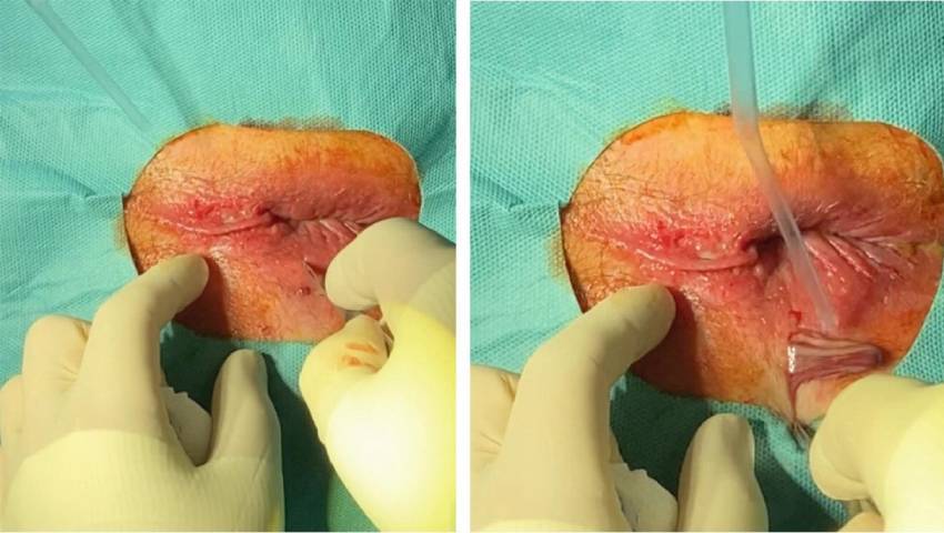 Chronic Fistula: What Happens When an Anal Abscess Isn’t Fully Treated?