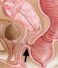 Diagram showing rectovaginal fistula