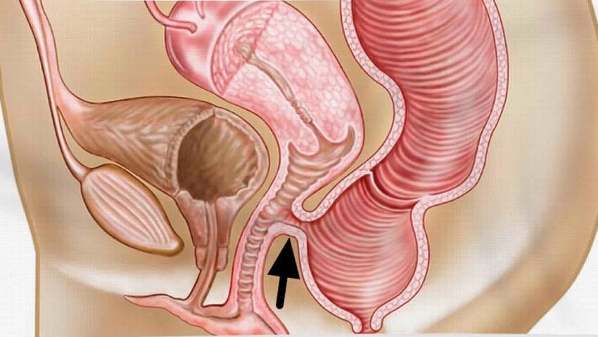 How to Recognize the Early Signs of a Rectovaginal Fistula