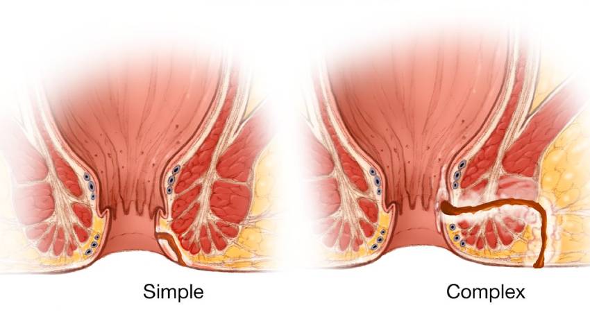 Simple vs. Complex Fistulas: Why the Classification Matters for Treatment