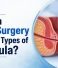 Can Laser Surgery Treat All Types of Fistula? Advanced Laser Fistula Treatment at Kaizen Fistula Care