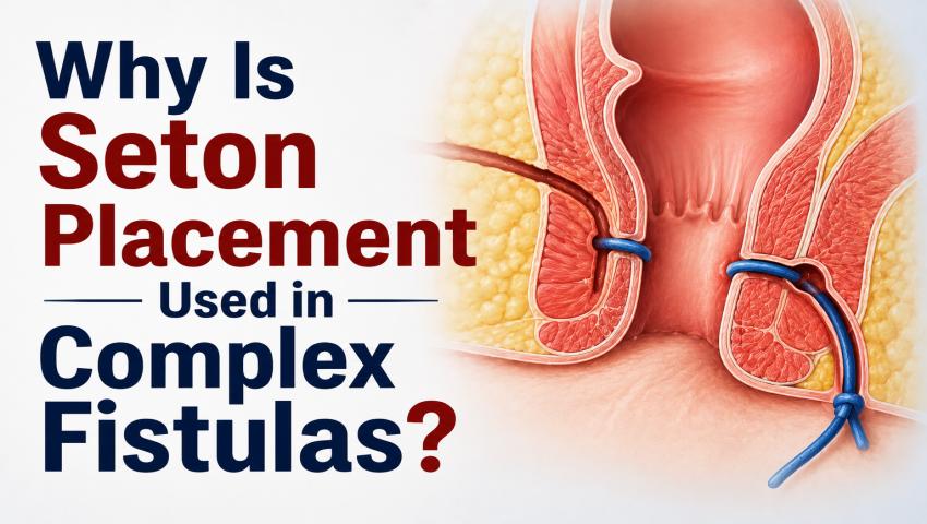 Why Is Seton Placement Used in Complex Fistulas?