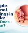 Multiple external openings in anal fistula explained by Dr. Samrat Jankar, showing causes, symptoms, diagnosis, and treatment options for complex anal fistulas.