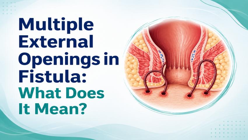 Multiple External Openings in Fistula: What Does It Mean?